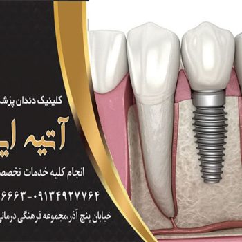 فواید و مزایای ایمپلنت دندان