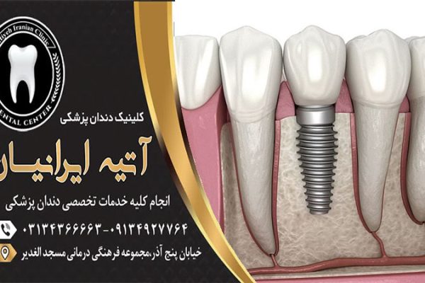 فواید و مزایای ایمپلنت دندان