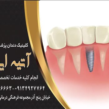 گران ترین نوع ایمپلنت دندان