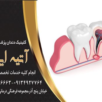 درمان کیست زیر دندان عصب کشی شده