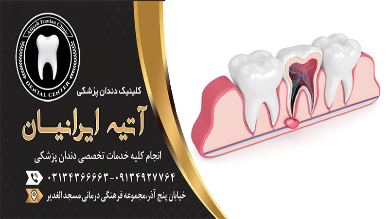درمان کیست زیر دندان عصب کشی شده