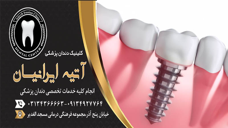 فواید ایمپلنت دندان بدانید