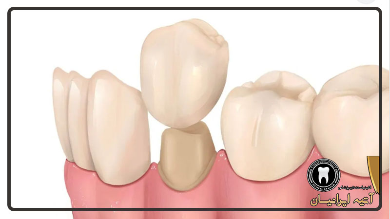روکش فول سرامیک دندان چیست؟