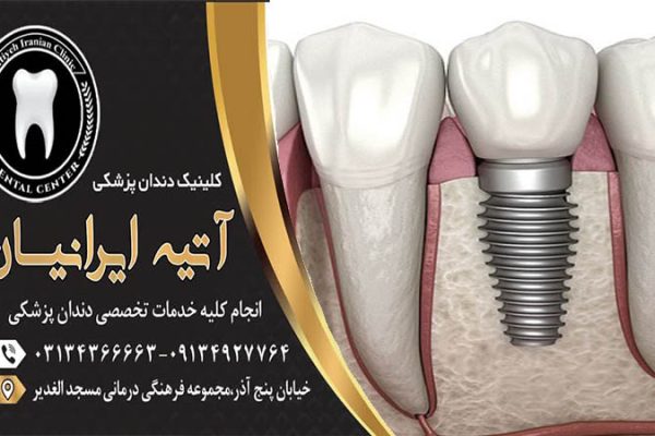 مضرات ایمپلنت دندان را بدانید