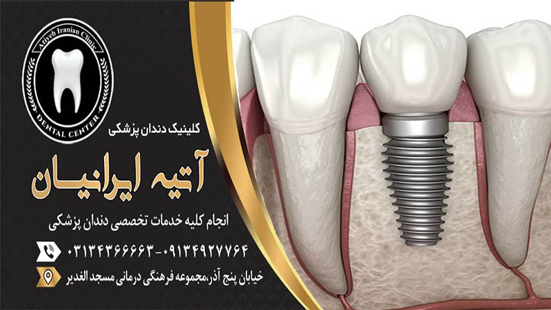 مضرات ایمپلنت دندان را بدانید