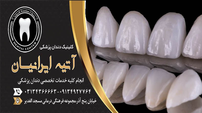 روکش فول سرامیک دندان چیست؟