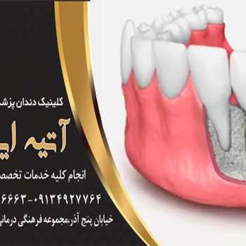 پیوند دندان چیست؟