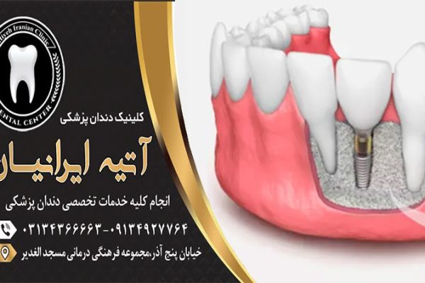 پیوند دندان چیست؟